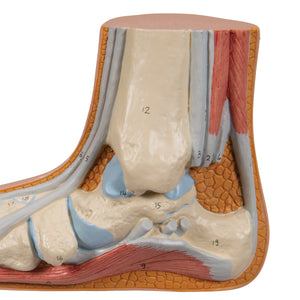 Squelette d'un pied plat (Pes Planus) - 3B Scientific